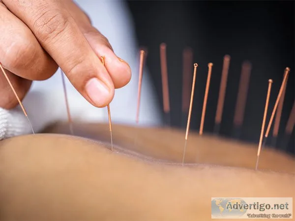Get acupuncture treatment nearby your location