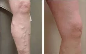 Best varicose veins doctor in jaipur