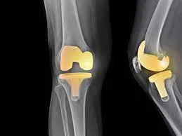 Best knee replacement surgeon in jaipur, rajasthan