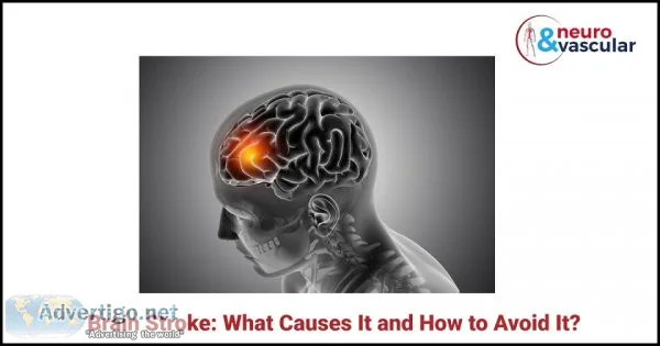 Brain stroke: what causes it and how to avoid it?