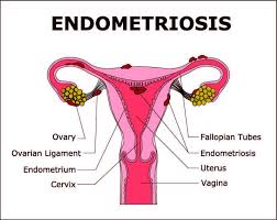 Best endometriosis doctor in jaipur