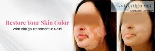 Vitiligo treatment in delhi | dr shankila mittal