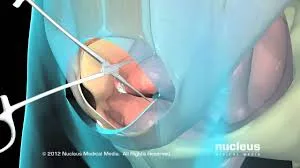 Hysterectomy operation in jaipur