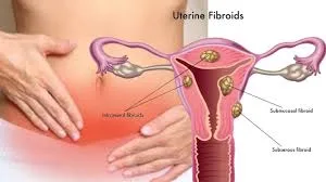 Hysterectomy operation in jaipur