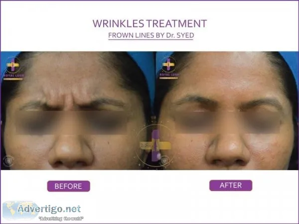 Anti wrinkle treatment in delhi | dr syed hussain