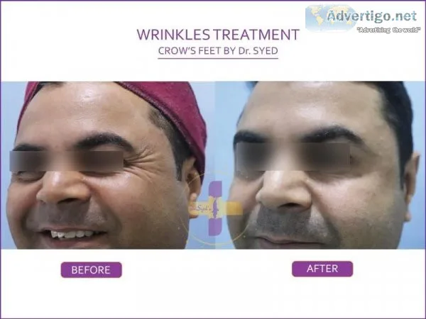 Anti wrinkle treatment in delhi | dr syed hussain