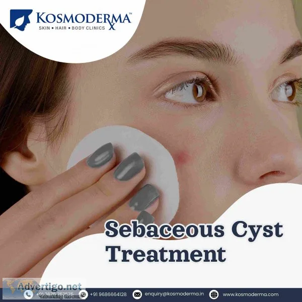 Kosmoderma sebaceous cyst treatment 