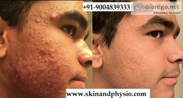 Best treatment for acne /pimples