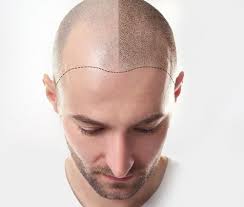 Hair fall treatment in jaipur