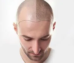 Hair fall treatment in jaipur