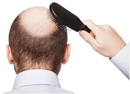 Hair fall treatment in jaipur