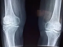 Best orthopedic doctor in kothrud pune | best orthopedic clinic 