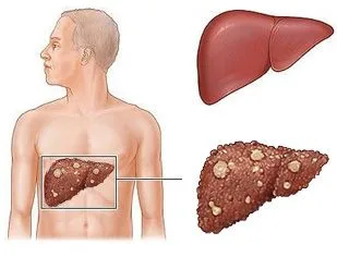Affordable liver transplant cost in india