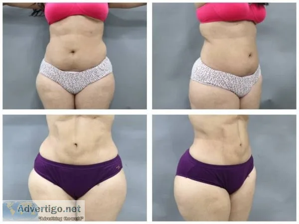 Liposuction cost in delhi - handa aesthetics