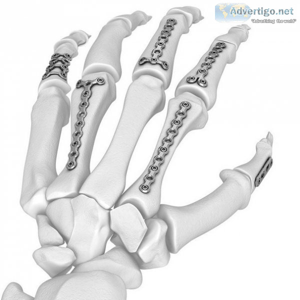 High-quality orthopedic implants plates