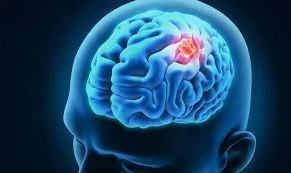 Best head cancer doctor in jaipur