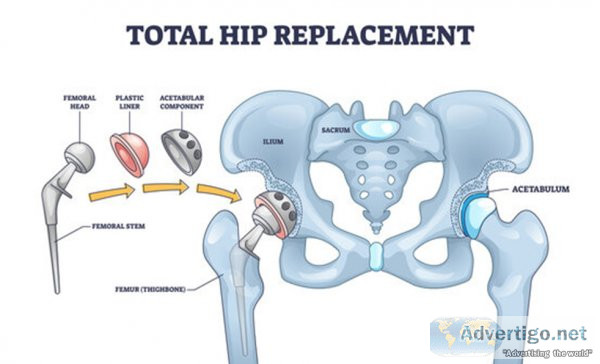 Hip replacement surgeons in kothrud | best hip replacement docto