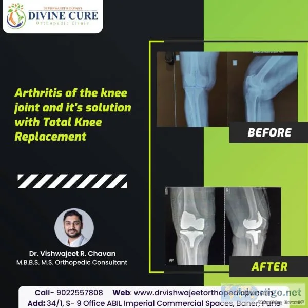 Best knee replacement surgeon in baner- dr vishwajeet chavan
