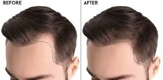 Is hair transplant permanent-medlinks