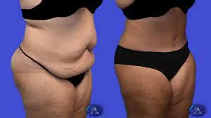 Tummy tuck surgery in gurgaon-handa aesthetics