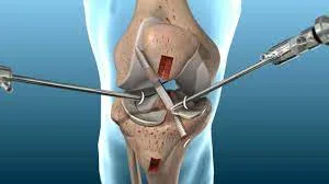Best acl surgeon in delhi- dr vikram mhaskar
