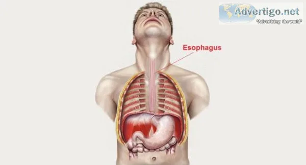 Esophageal cancer treatment in delhi -dr arvind