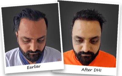 Where to find the best hair transplant clinic in delhi?