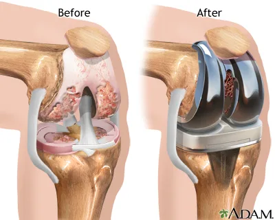 Knee replacement surgery cost in india -dr vikram mhaskar
