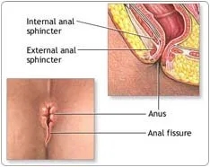 Best hospital for fissure surgery in delhi-irene hospital