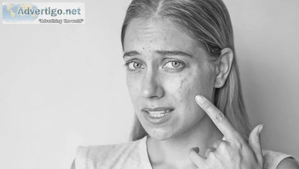 Best acne treatment in delhi dr rajat kandhari