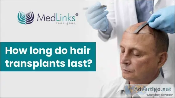 How long do hair transplants last-medlinks