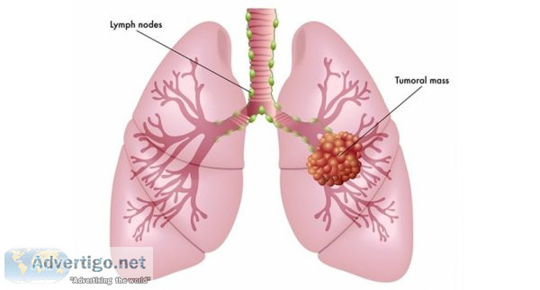 Lung cancer treatment cost in india - dr arvind kumar