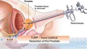 Turp surgery in delhi- irenehospital