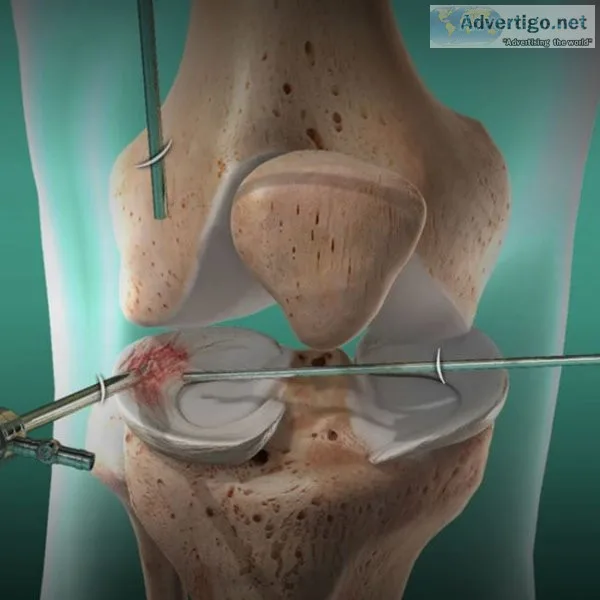 Best arthroscopy surgery in jaipur