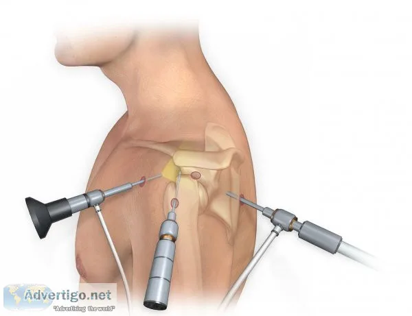 Best arthroscopy surgery in jaipur
