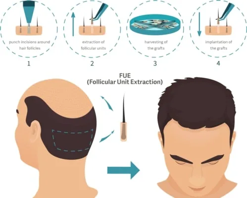 Hair transplant cost in delhi -gaurav garg