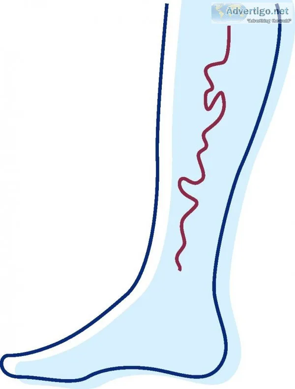 Best varicose veins doctor in mumbai