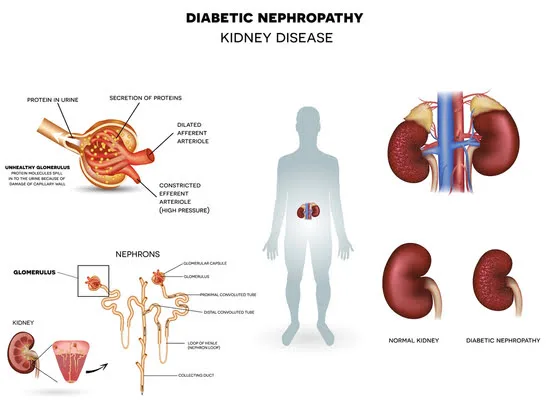 Ayurvedic treatment for diabetic nephropathy