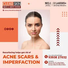 Best advance acne scar removal treatment in india || laser treat