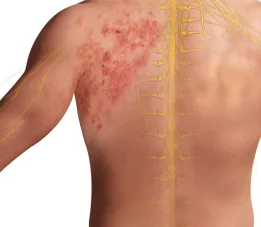 Herpes neuralgia treatment in jaipur