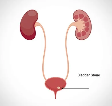 Bladder stone surgery cost in delhi
