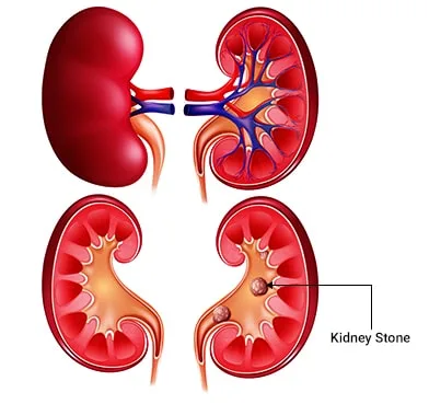 Kidney stone surgery cost in delhi