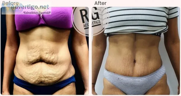 Tummy tuck procedure in delhi | dr rajat gupta