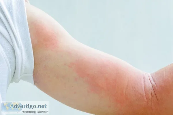 Allergy treatment in jaipur