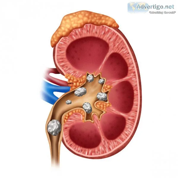 Best treatment for kidney stones