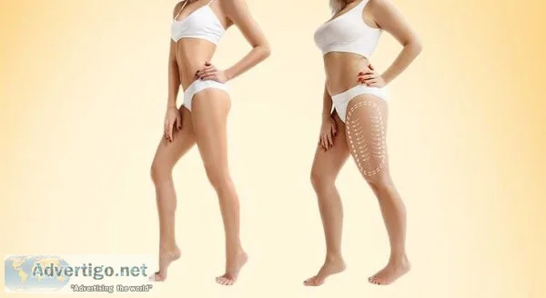 Best liposuction treatment in dubai| liposuction cost in dubai -