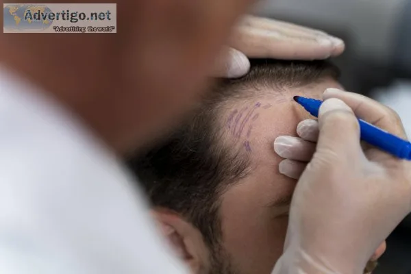 Hair transplantation