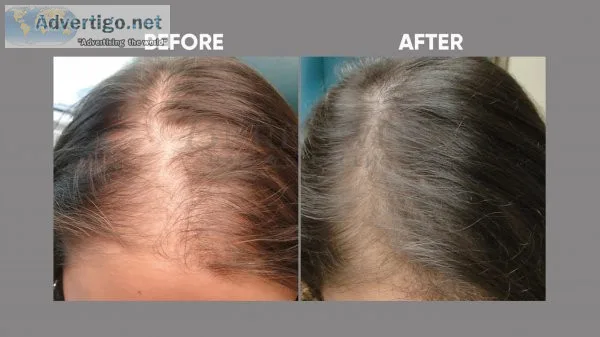 Female hair transplant in delhi, india | female hair transplant 
