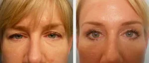 Best eyebrow lift treatment in gurgaon at best prices
