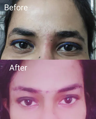 Best eyebrow lift treatment in gurgaon at best prices